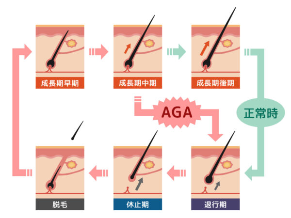 AGA治療