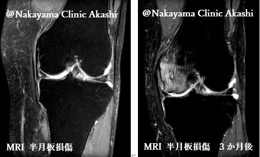 MRIの半月板損傷の様子