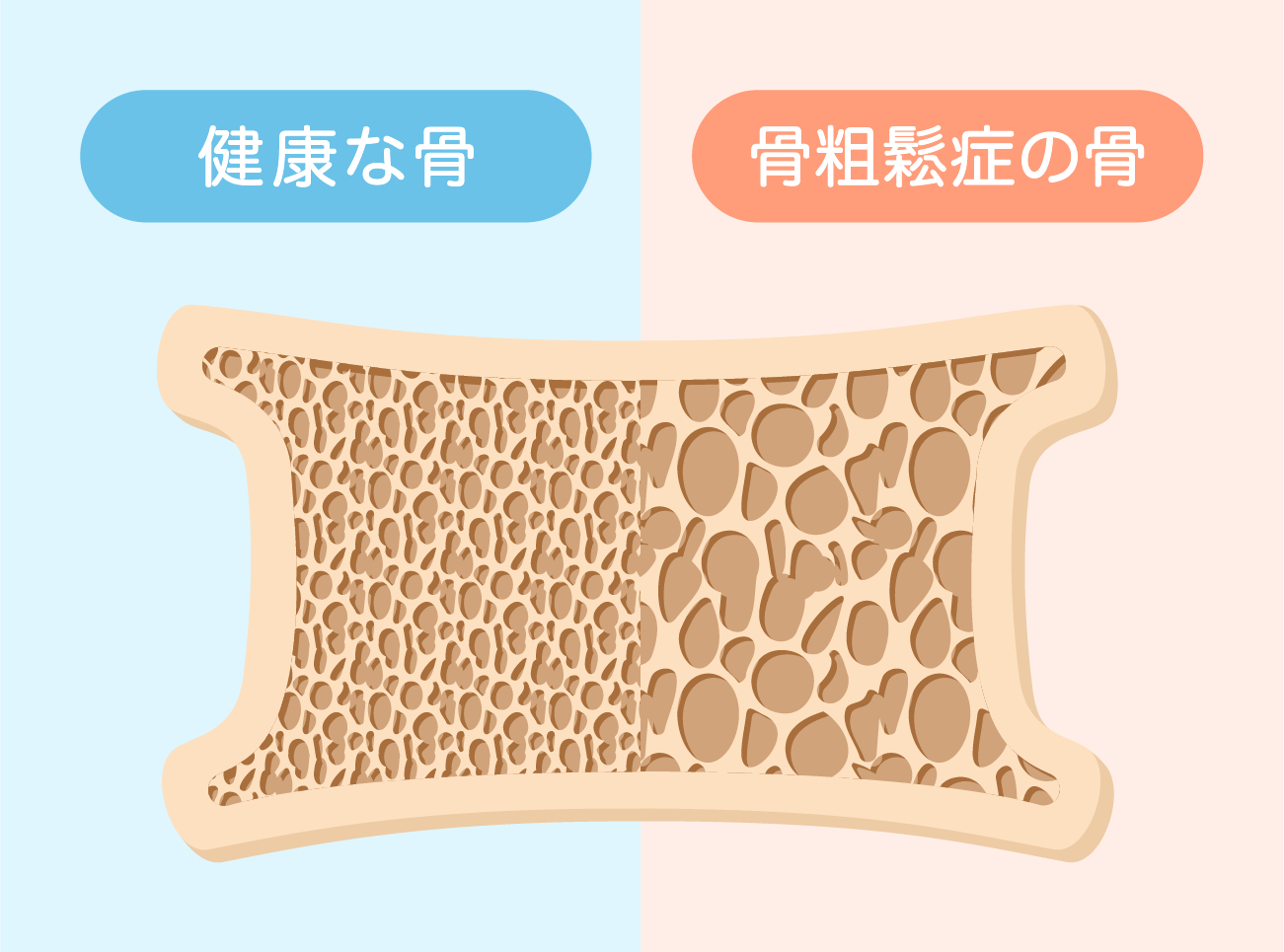 骨粗しょう症の例