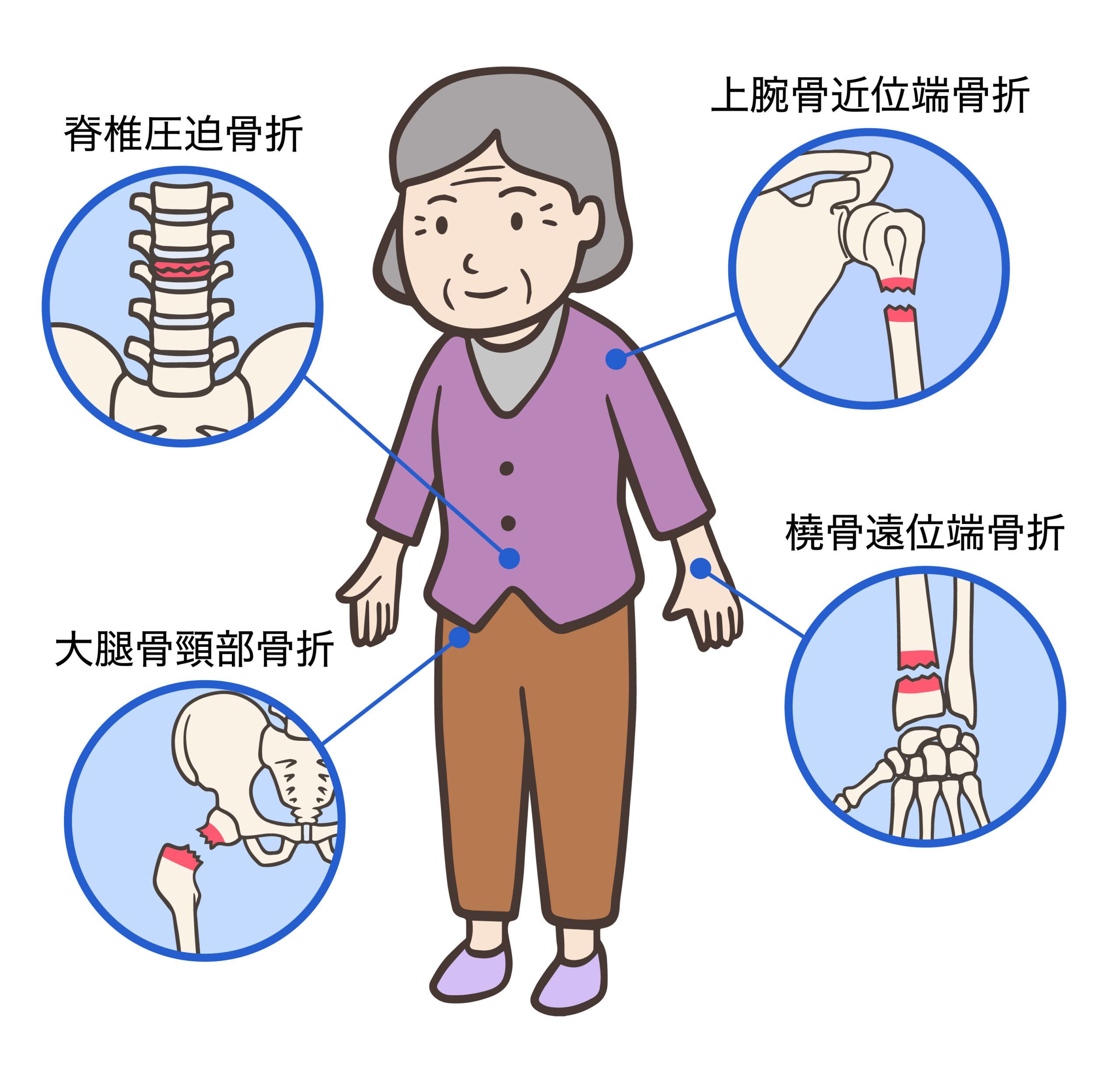 高齢者に多い骨折の例